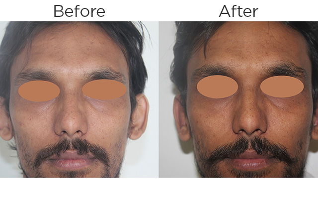 Aesthetique_Otoplasty_Before & After_01